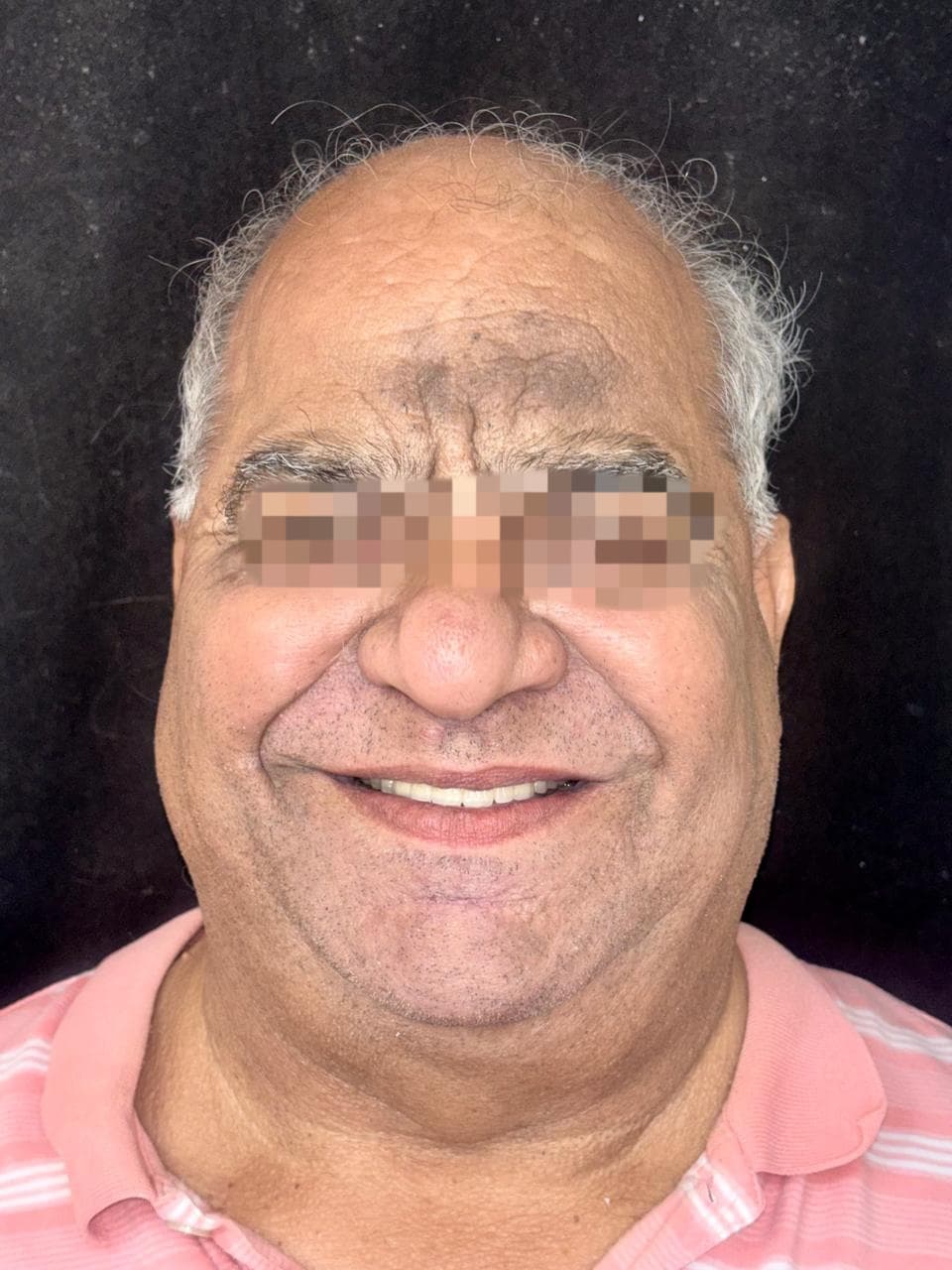 Craniofacial Implants result 1