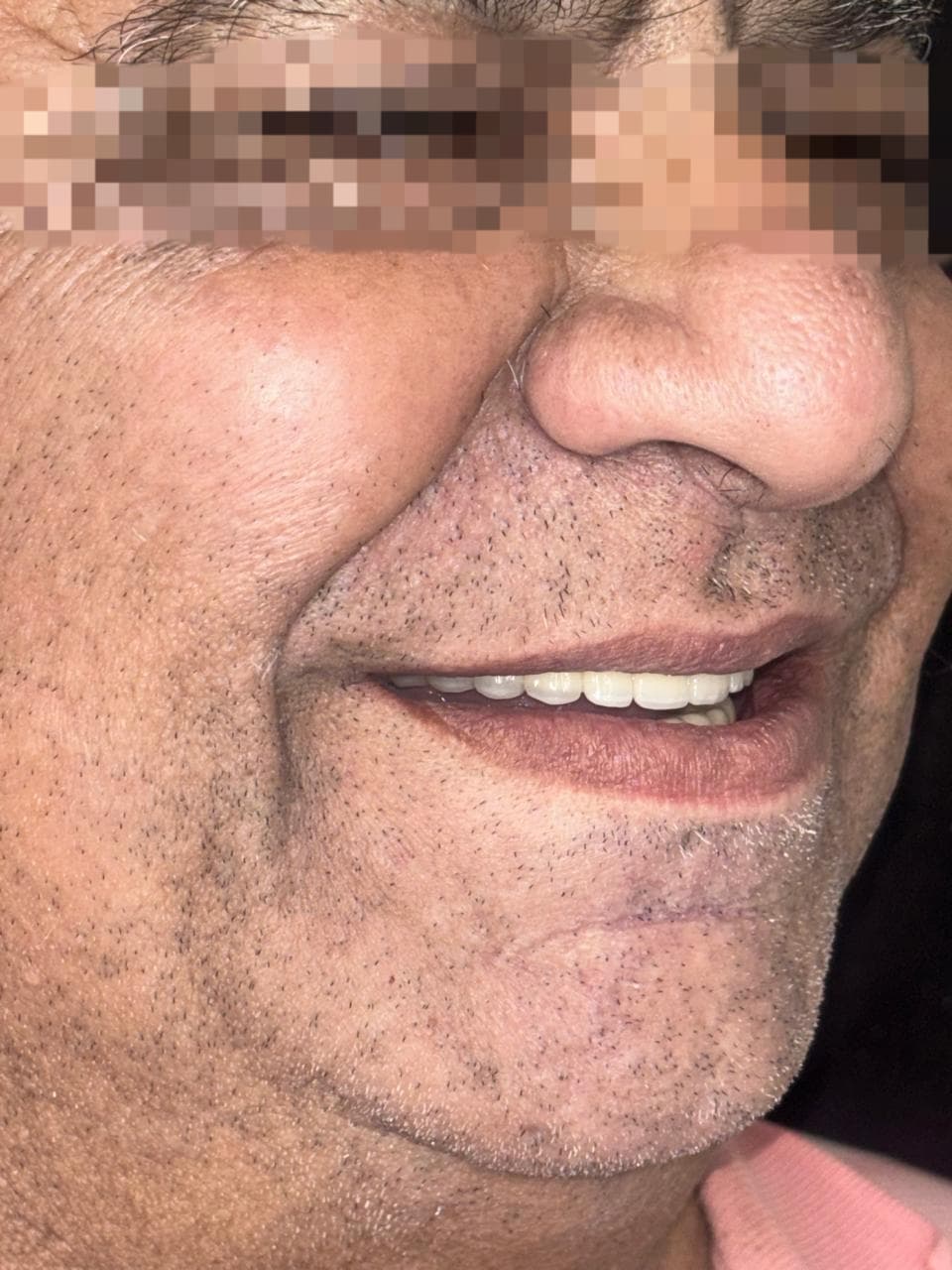 Craniofacial Implants result 2