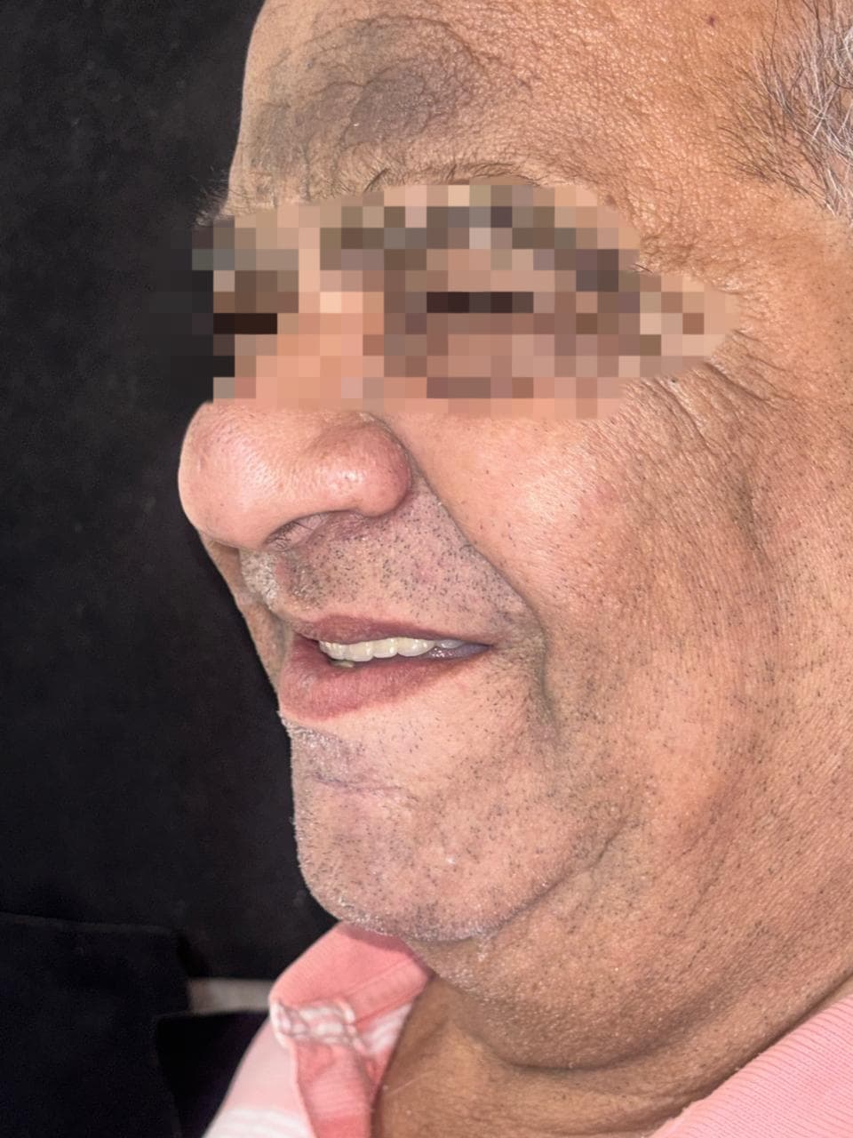 Craniofacial Implants result 3