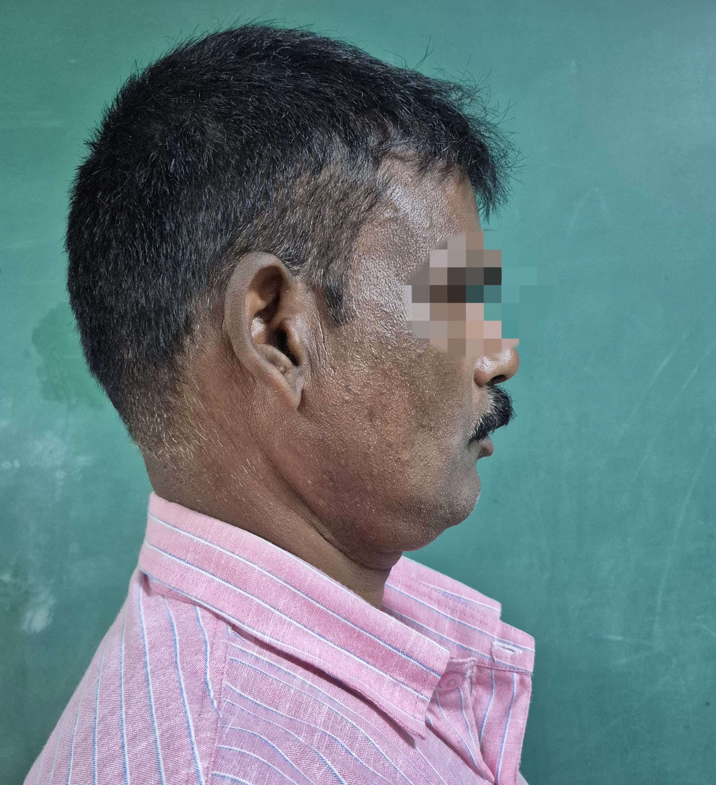Oral Cancer result 2