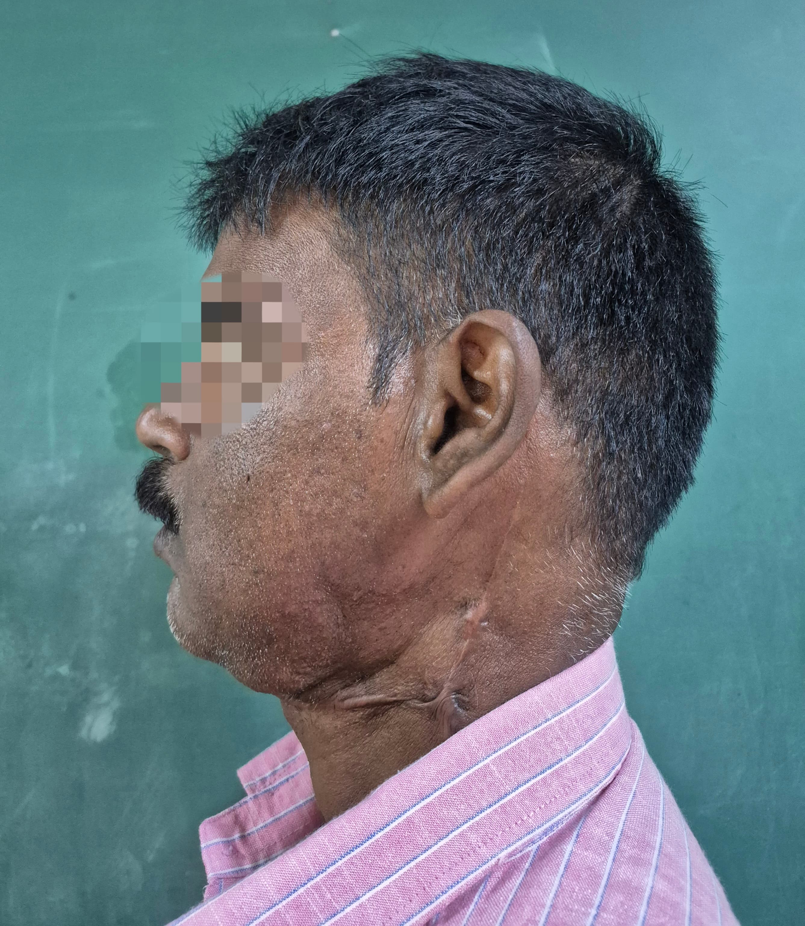 Oral Cancer result 3