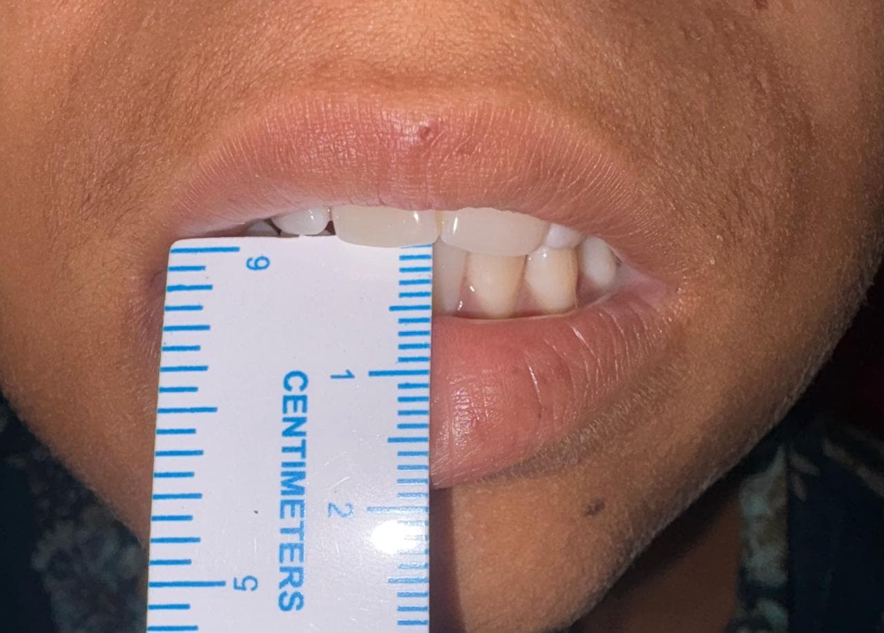 TMJ Disorders result 1