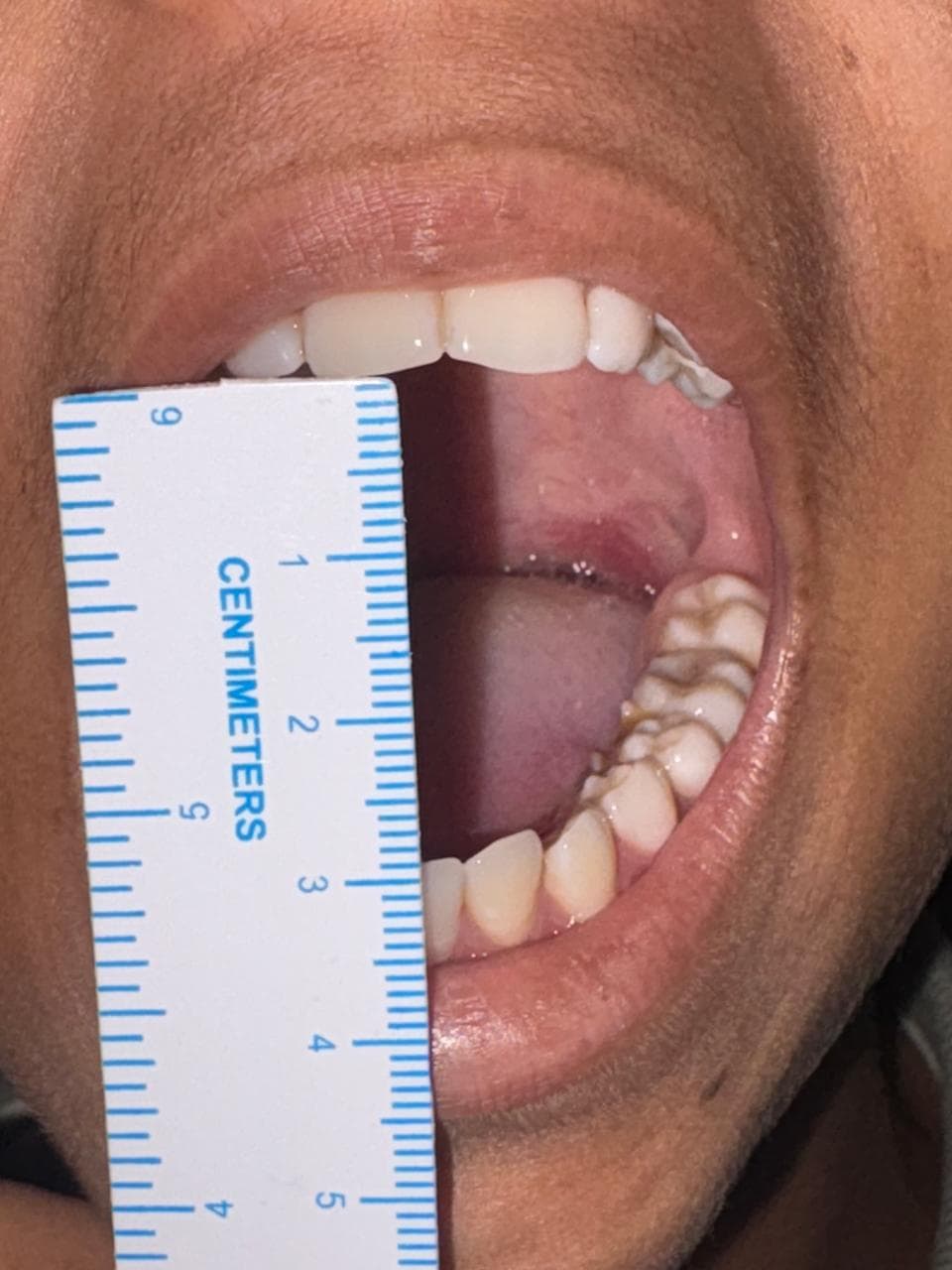 TMJ Disorders result 2